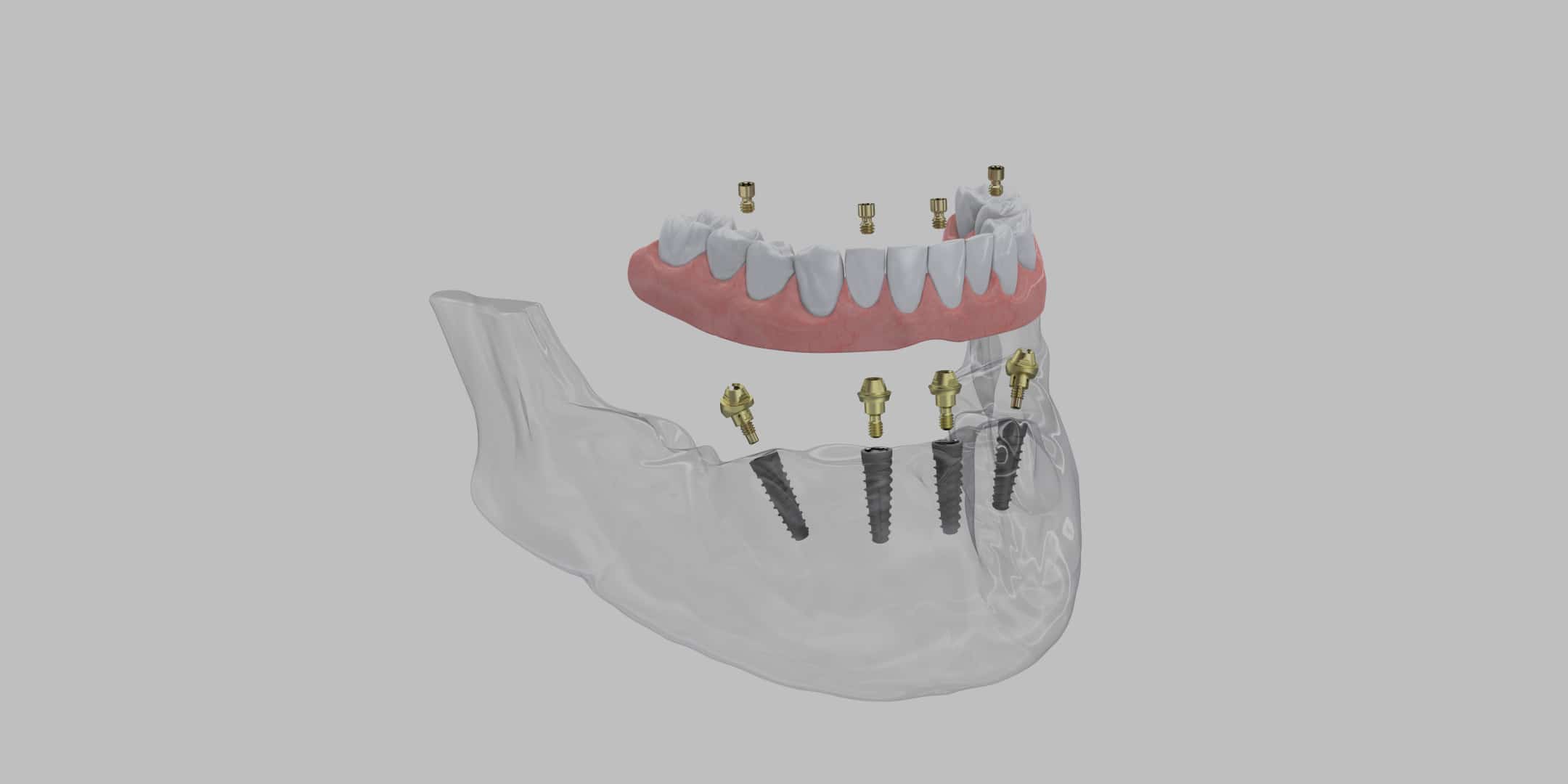 Hållbara tänder med tandimplantat